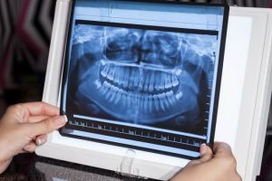 Panoramic X-Ray Clinic: What It Is and Why It Matters for Your Dental Health